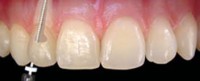 Endodontia (Canal)
